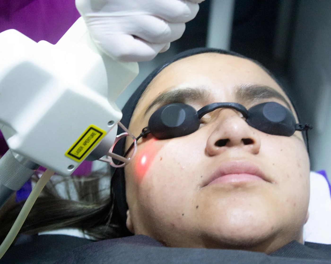 Láser CO₂ fraccionado · Haut Klinik