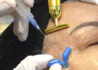 Aplicación de bioestimuladores en Haut Klinik.